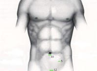 Schnittfuhrung laparoskopische Operation